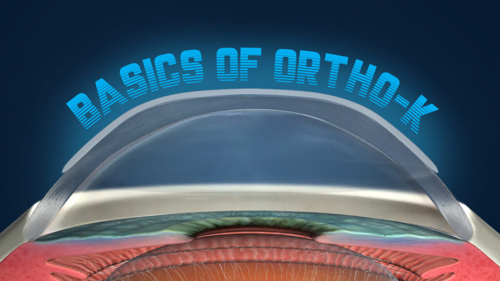 Basics of OrthoK