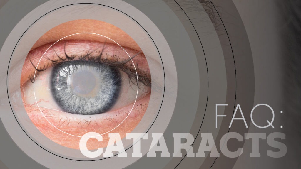 FAQ Cataracts